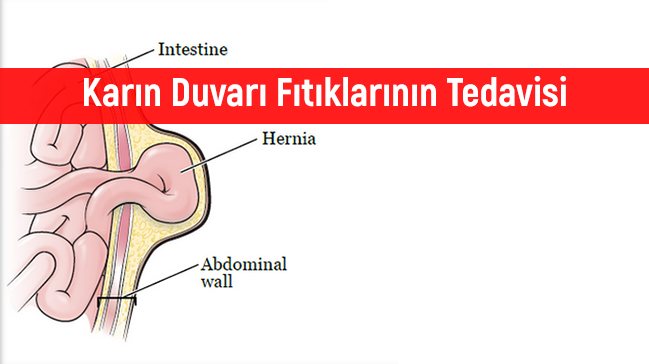 Karın Duvarı Fıtıklarının Tedavisi