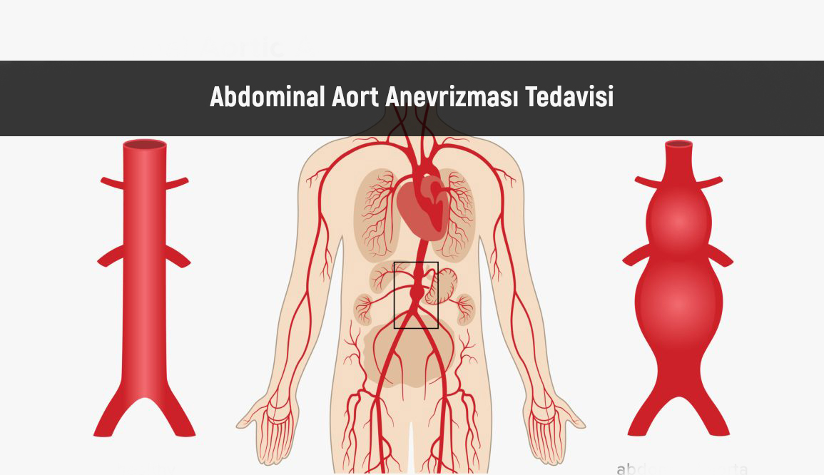 Abdominal Aort Anevrizması Nedenleri ve tedavisi