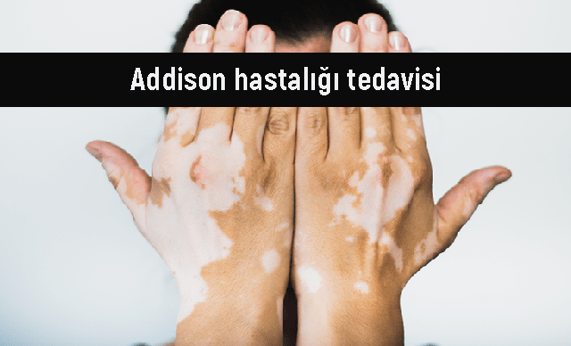 Addison hastalığı tedavisi