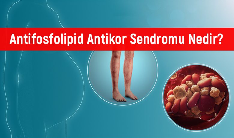 Antifosfolipid sendromu nasıl tedavi edilir?