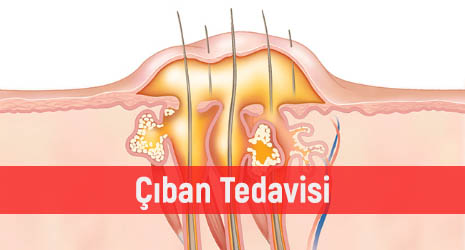 Çıban Nedir? Çıbanın Belirtileri ve Tedavisi