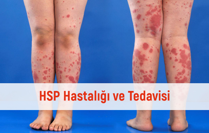 HSP hastalığı ne kadar sürer?