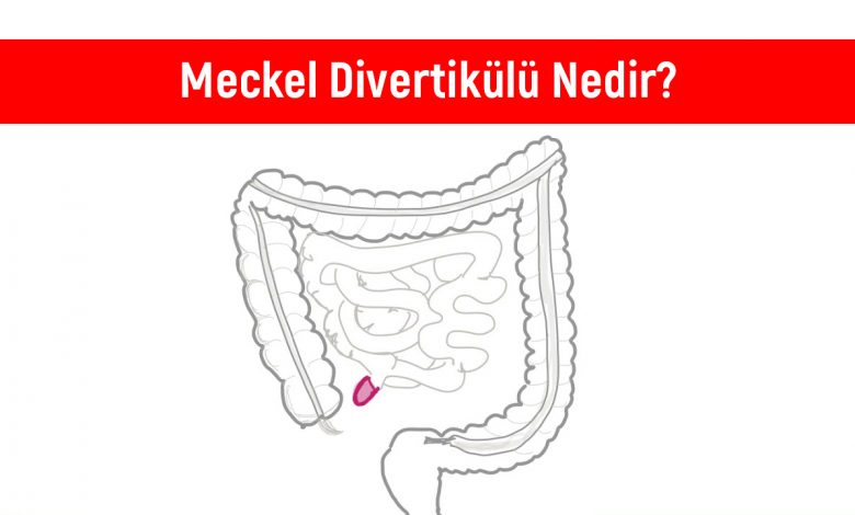 Meckel Divertikülü Tedavisi