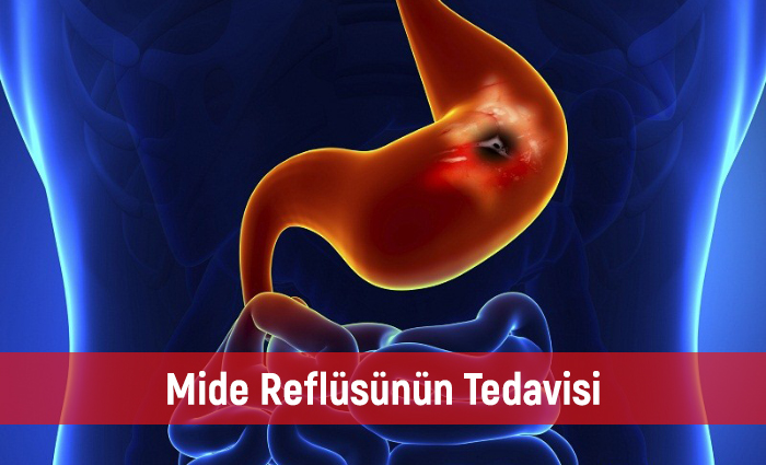 Mide Reflüsünün Tedavisi