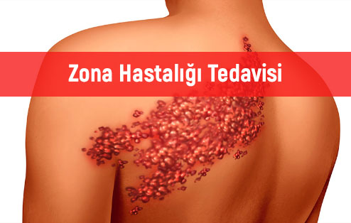 Zona hastalığı nedir? Zona hastalığı belirtileri ve tedavisi