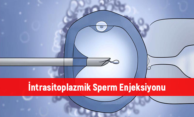 İntrasitoplazmik Sperm Enjeksiyonu