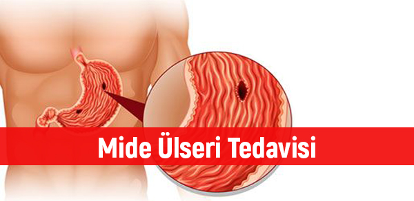 Mide Ülseri Tedavisi