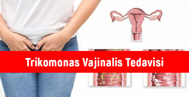 Trikomonas Vajinalis Tedavisi