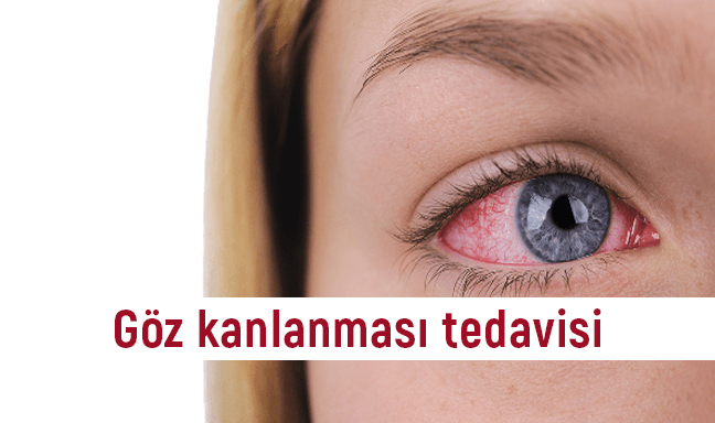 Göz kanlanması neden olur ? Göz kanlanması tedavisi