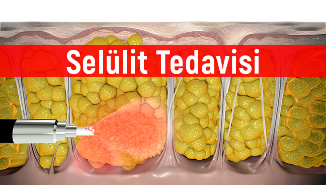 Selülit Nedir? Selülit Belirtileri Ve Tedavisi