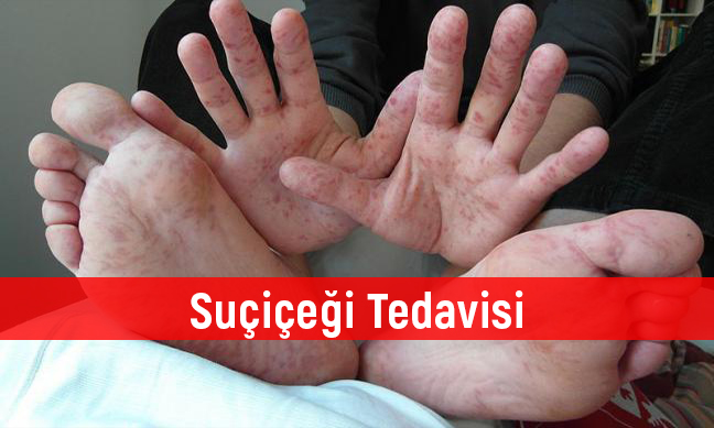 Suçiçeği ve Suçiçeği Tedavisi