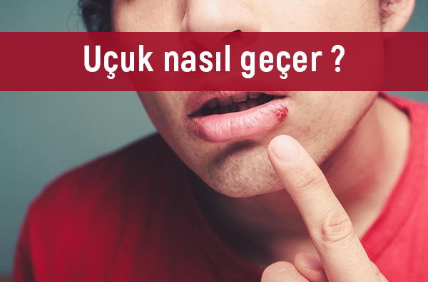 Uçuk nasıl geçer 