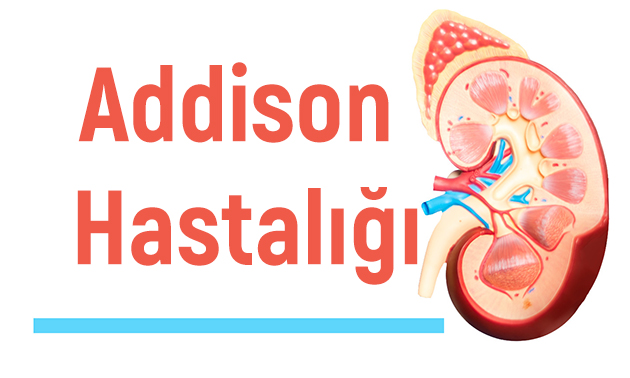 Addison hastalığı belirtileri, addison hastalığı tedavisi