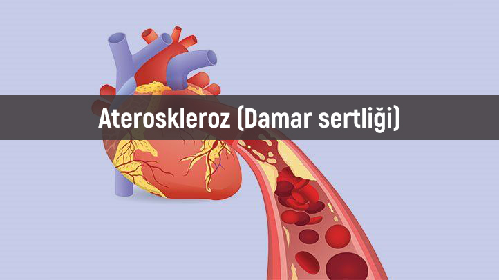 Ateroskleroz (Damar sertliği) nedir? Tedavisi