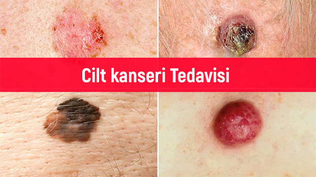 Melanom Cilt Kanseri﻿ Kanseri Belirtileri Tedavisi 