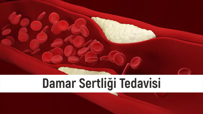 Ateroskleroz (damar sertliği) Tanı ve Tedavisi