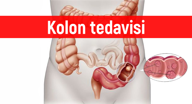 Kolon kanseri belirtisi ve tedavisi