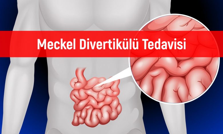 Meckel Divertikülü Tedavisi