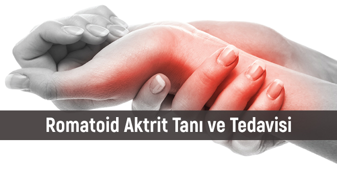 Romatoid Aktrit Tanı ve Tedavisi