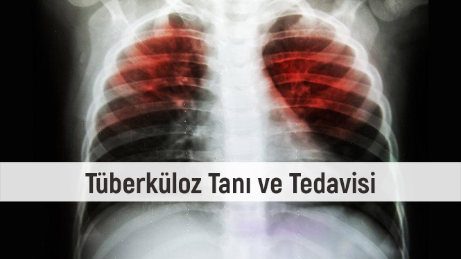 Tüberküloz Tanı ve Tedavisi