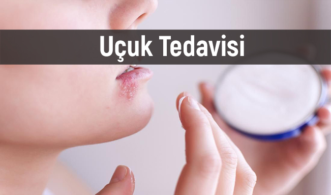 Uçuk Nedir Belirtileri Tedavisi