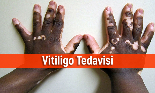 Vitiligo hastalığı nedir? Belirtileri ve tedavisi