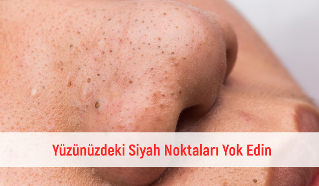 Yüzünüzdeki Siyah Noktaları Yok Edin