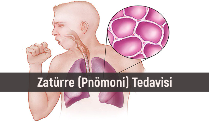 Zatürre (Pnömoni) Nedenleri, Tanı ve Tedavisi