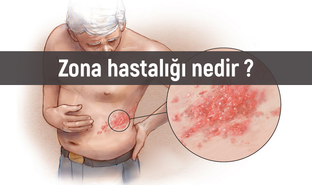 Zona (herpes zoster) Tanı ve Tedavisi