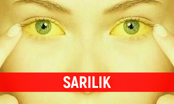 sarılık