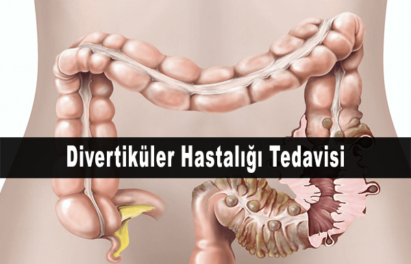 Divertiküler Hastalığı Tedavisi