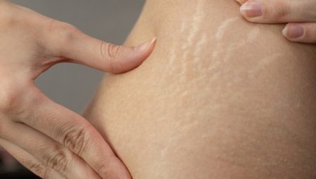 Striort Çatlak Tedavisi: Hamilelik veya Derin Kilolar Sonucunda Oluşan Çatlakların Azaltılması